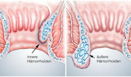 女性混合痔疮手术视频,女性混合痔疮手术过程解析与康复指导